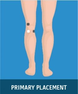 Degenerative Arthritis (Knee)